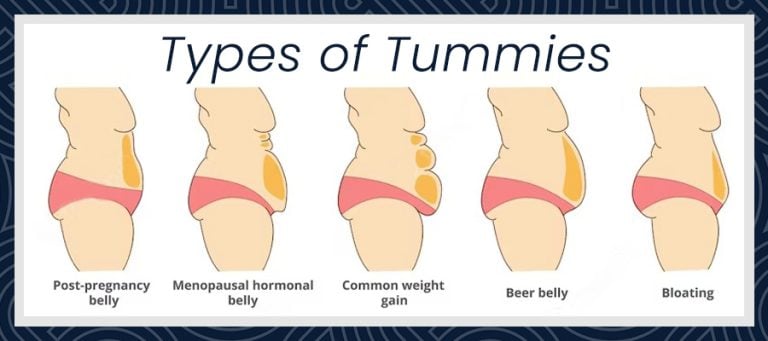 What is a Tummy Tuck Turkey?