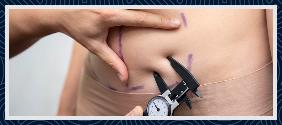 What is a Tummy Tuck Turkey? 2 What is a Tummy Tuck Turkey?