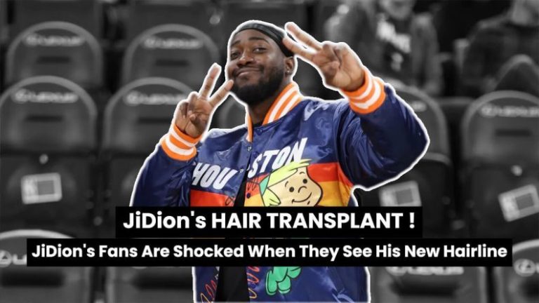 YouTube’un Şaka Yıldızı JiDion Saç Ekimi