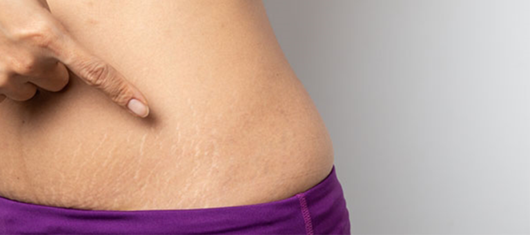 Mommy Makeover i Tyrkiet: