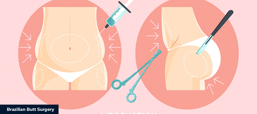 Achieving the Perfect Brazilian Butt 1 Brazilian Butt Liposuction