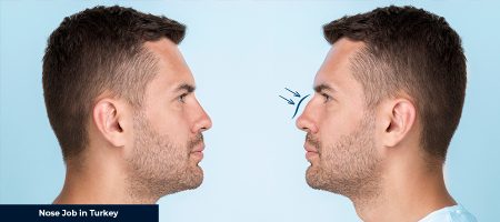 Nose Job in Turkey