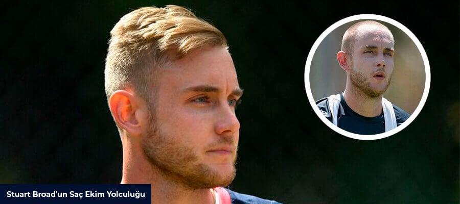 Stuart Broad Hair Transplant