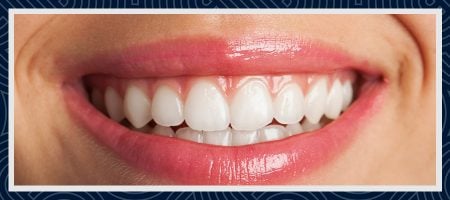 Understanding and Treating Gummy Smile