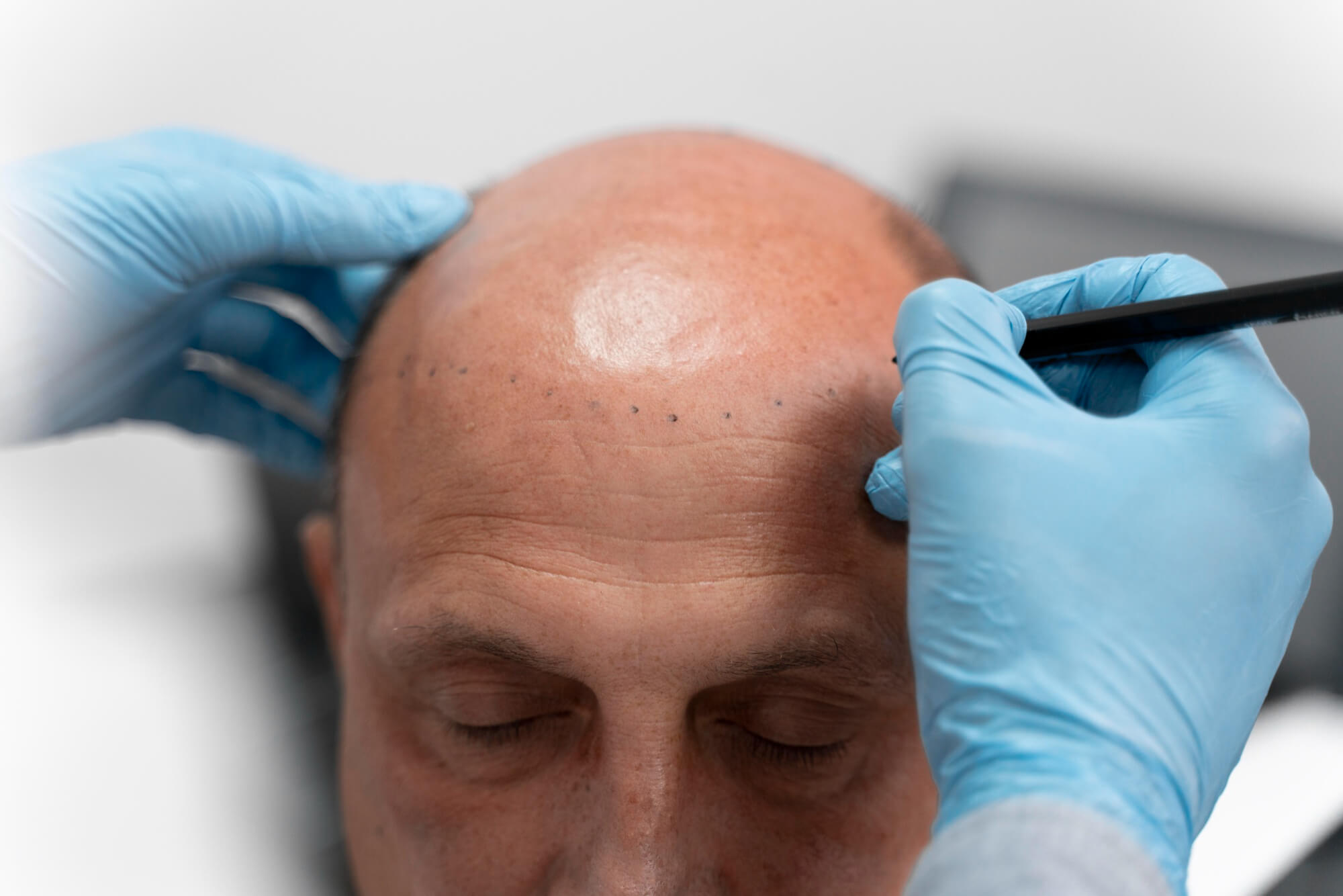 Bald Spot on Crown: How to Treat it 1 Bald Spot on Crown: How to Treat it