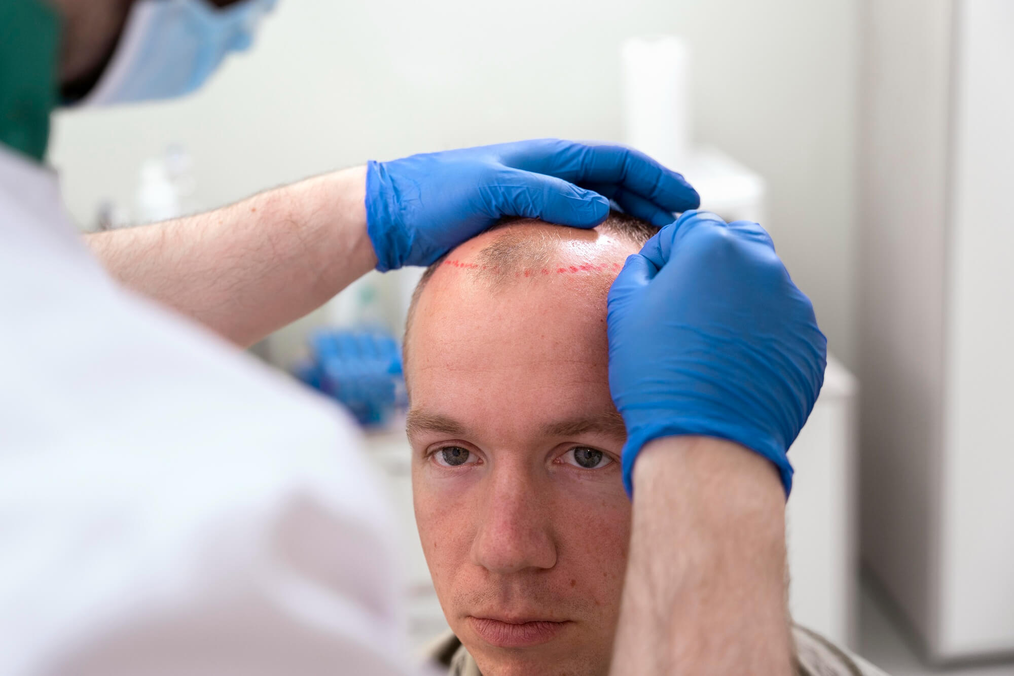 Bald Spot on Crown: How to Treat it 3 Bald Spot on Crown: How to Treat it