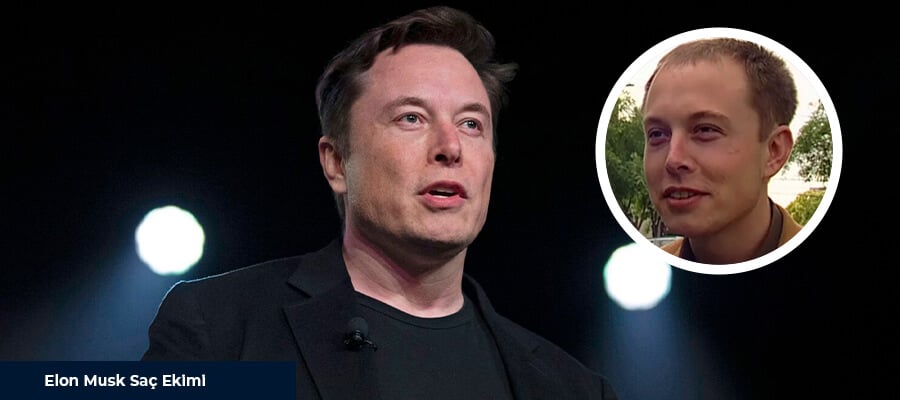Viaggio Nel Trapianto Di Capelli Di Elon Musk