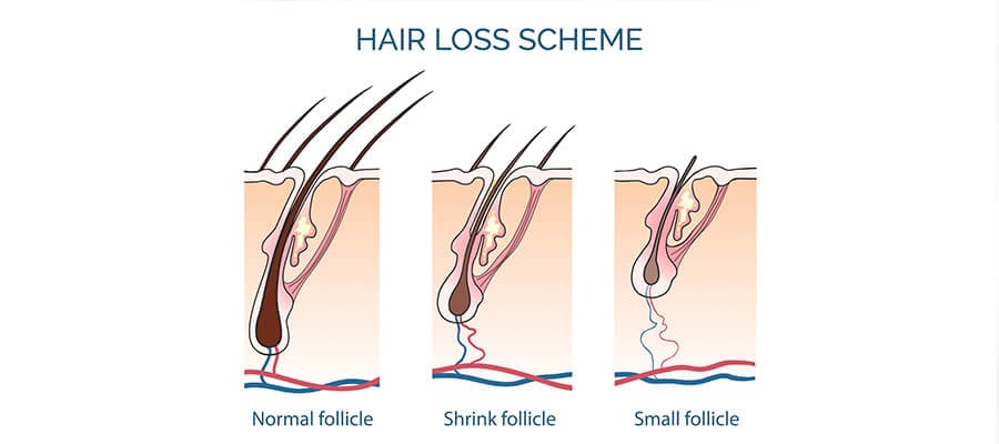 The Roadmap to Regrow Hair Naturally