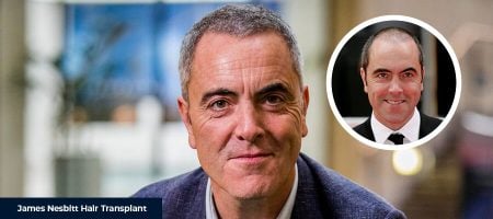 James-Nesbitt-Before-After