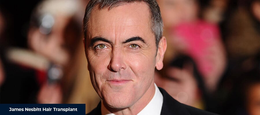 James Nesbitt Saç Ekimi