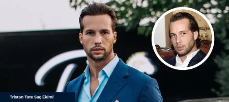 Tristan-Tate-Saç-Ekimi-Önce-Sonra