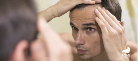 Antidepressant Induced Alopecia (1)