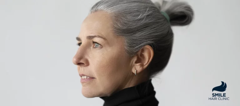 Frontal Fibrosing Alopecia