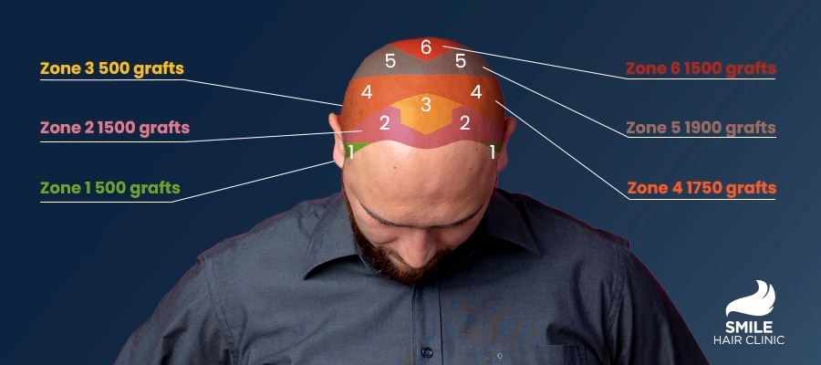 How Many Grafts Do I Need For My Hair Transplant