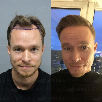 3300 Grafts - J. VOLDUM