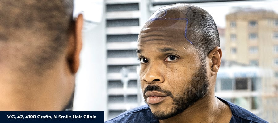 Afro Hair Transplant 1 Afro Hair Transplant