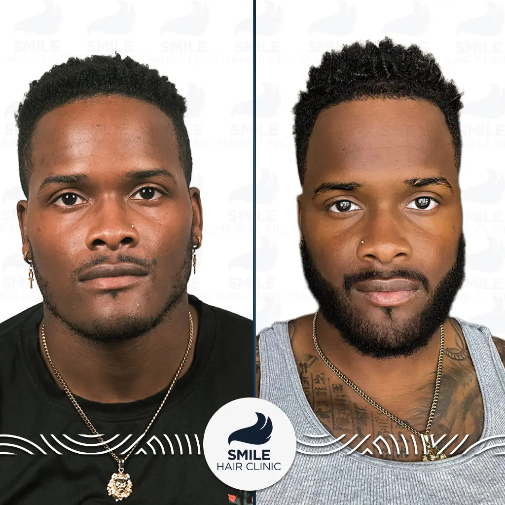 Afro Hair Transplant 4 Aquill Page afro hair transplant