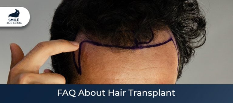 FAQ About Hair Transplant