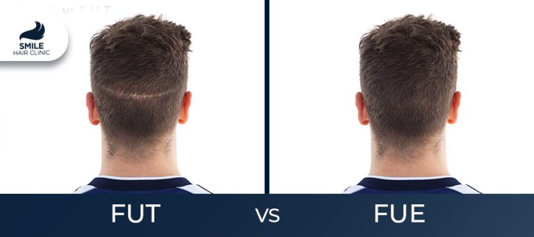 Differences Between FUT and FUE Hair Transplant