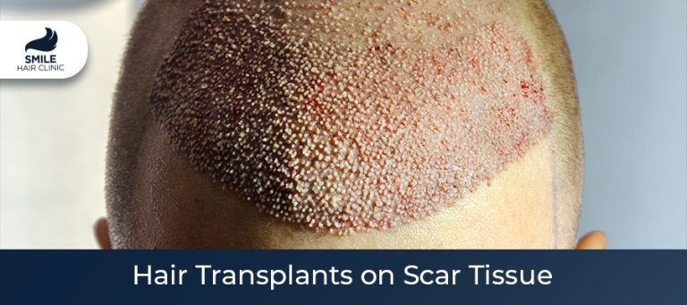 Hair Transplants on Scar Tissue