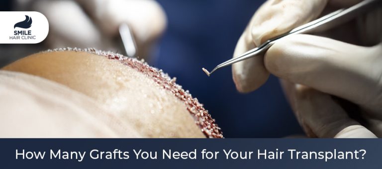 How Many Grafts You Need for Your Hair Transplant?