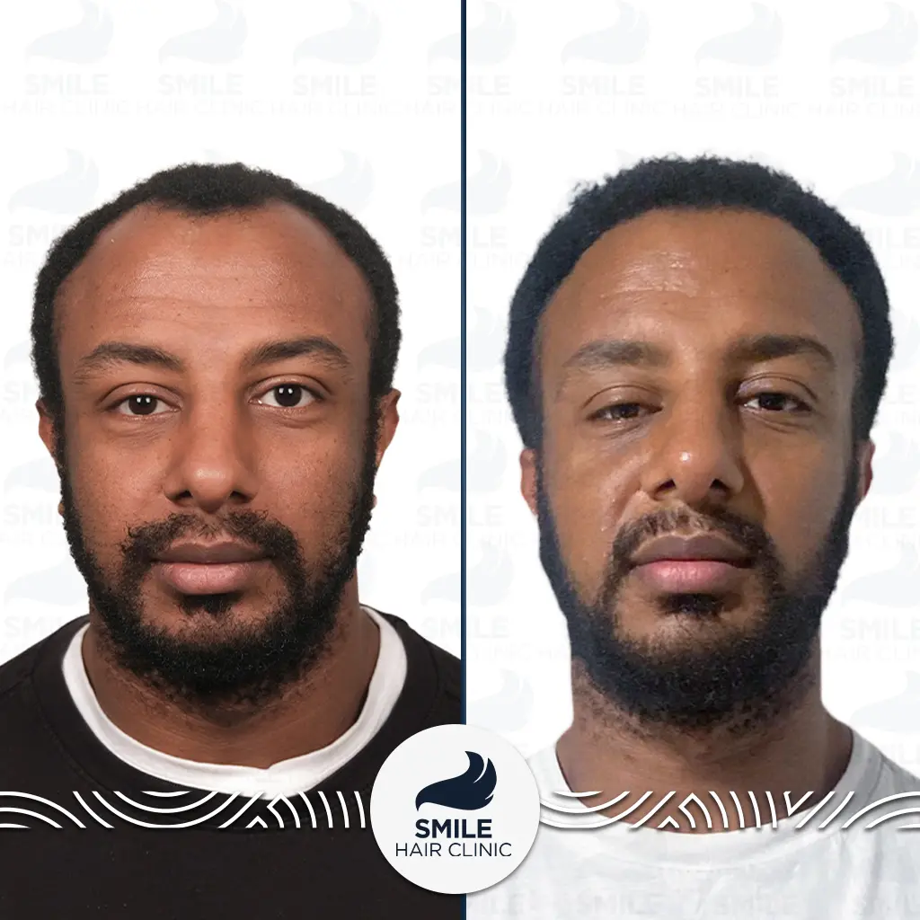 Afro Hair Transplant 3 Micael Newport afro hair transplant