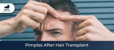 Pimples-After-Hair-Transplant