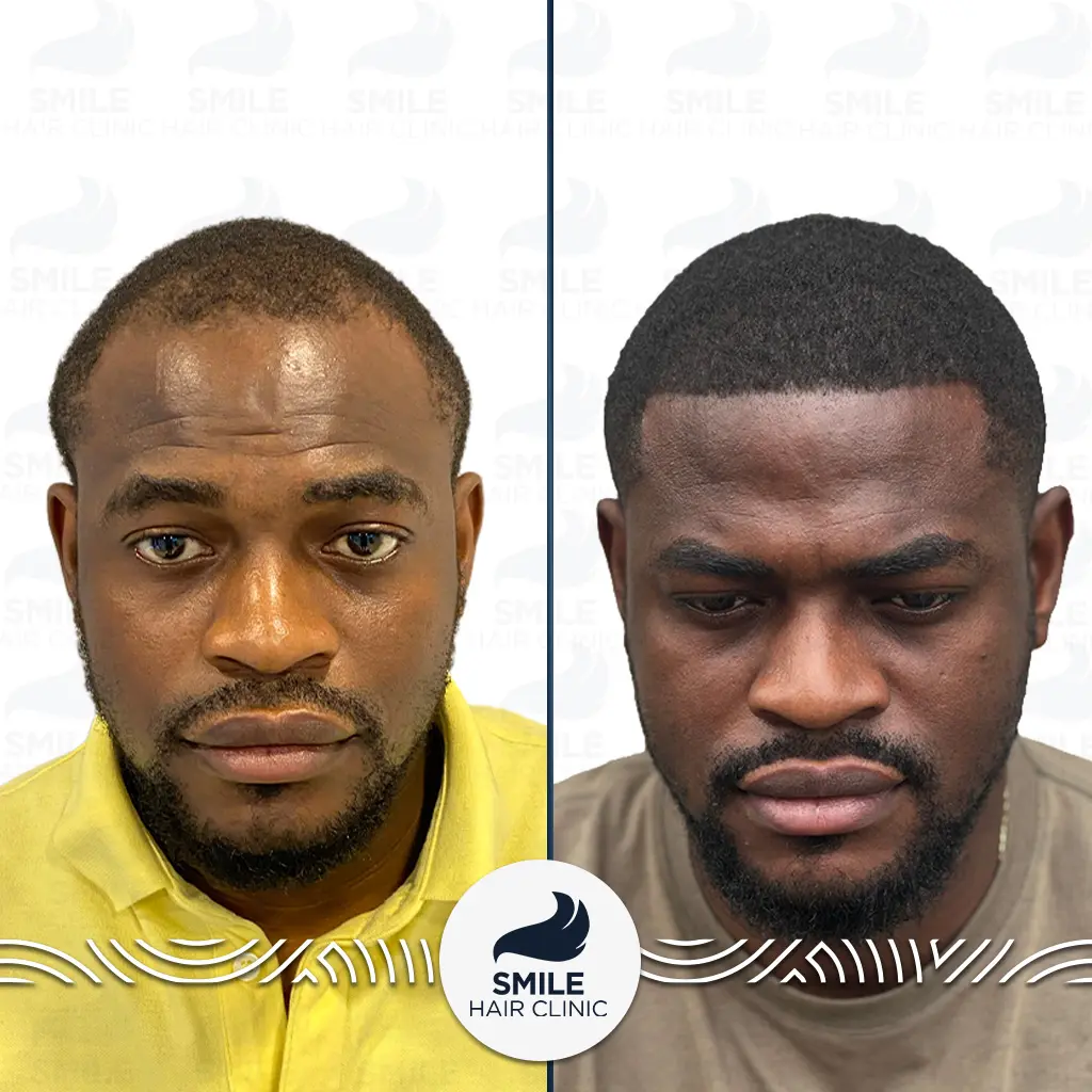 Afro Hair Transplant 2 STEVEN MAGBUTU BALEMBOLO
