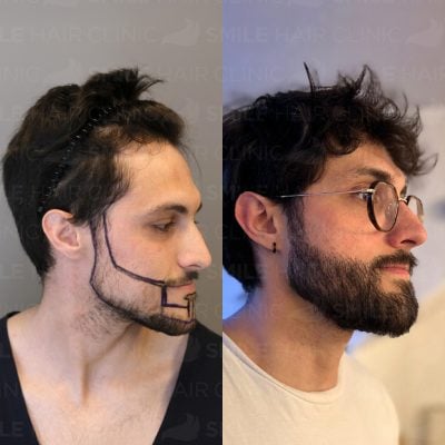 3700 Grafts - R. GELISKI