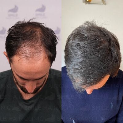 3800 Grafts - A.PELO