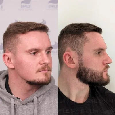 4100 Grafts - T. MACFARLANE