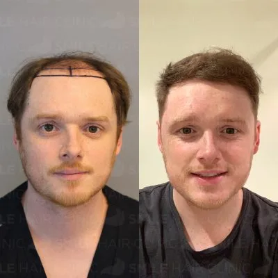 4500 Grafts - G. ALLEN