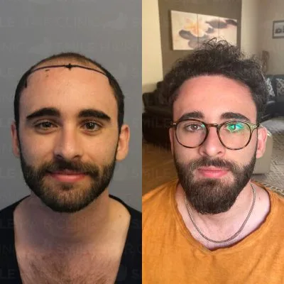 4600 Grafts- C. VELLA