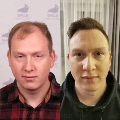 4750 Grafts - J. HESSLER