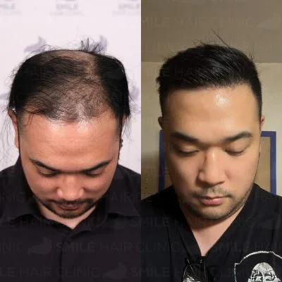 5000 Grafts - J. PINEDA