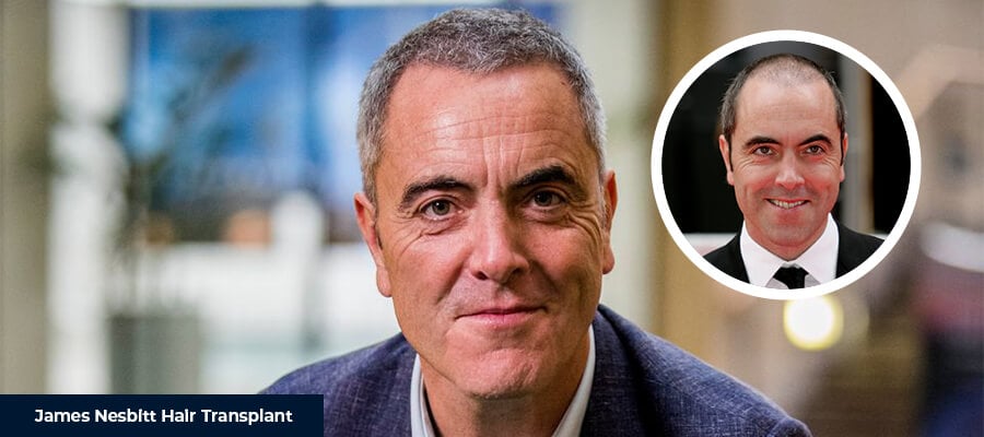 Il Trapianto di Capelli di James Nesbitt