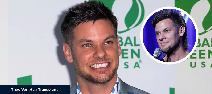 Theo Von Haartransplantation