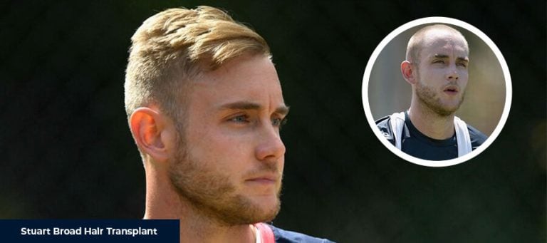 La Greffe de Cheveux de Stuart Broad
