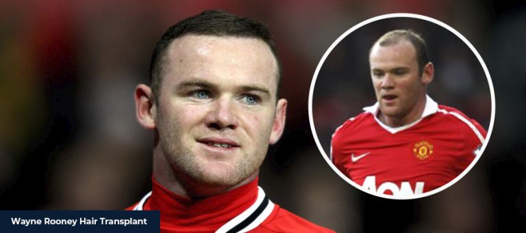 Wayne Rooney Haartransplantation