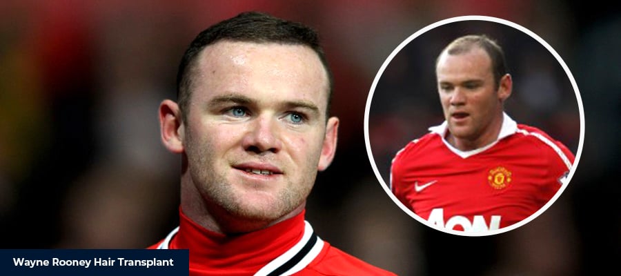 Hair Transplant Famous Actors: Celebrity Results, Techniques & What to Expect