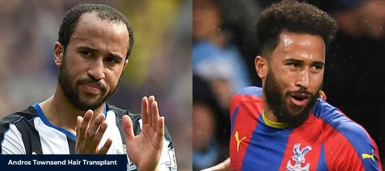 Andros Townsend’in Saç Ekimi Hikayesi
