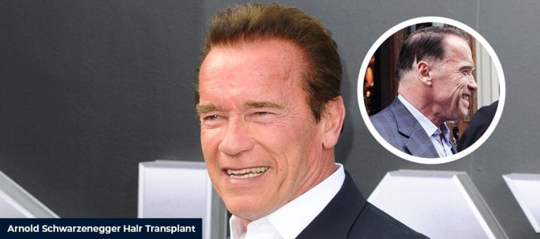 Arnold Schwarzenegger Saç Ekimi