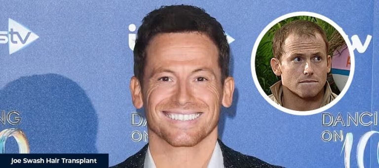 Joe Swash Saç Ekimi