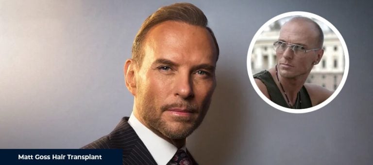 Matt Goss Saç Ekimi
