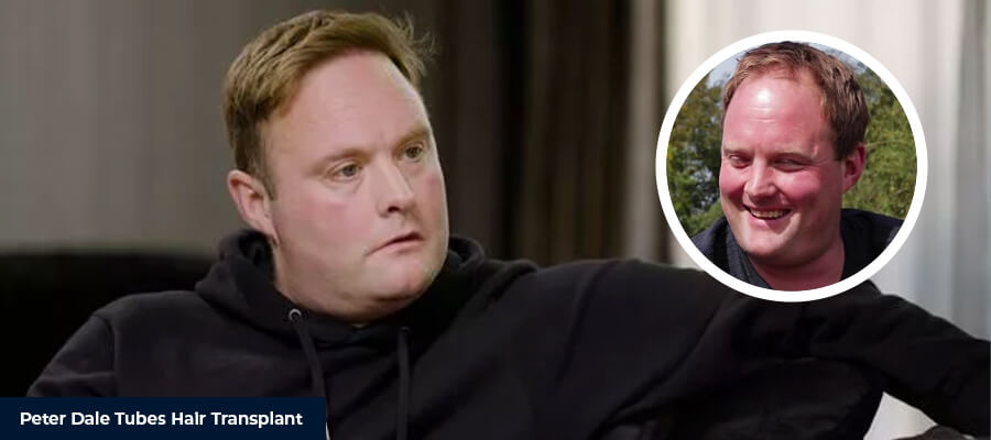 Peter Dale Tubes Hair Transplant