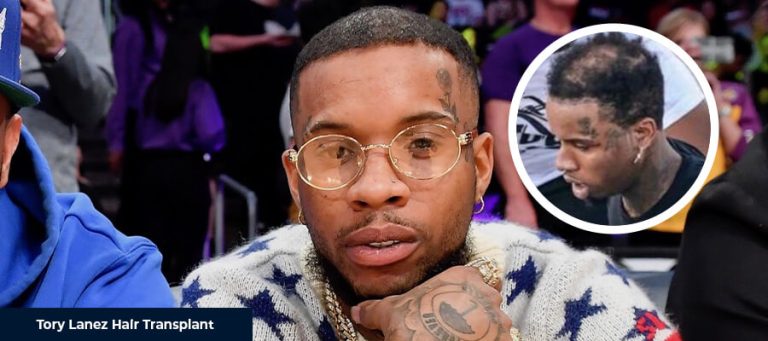 Tory Lanez Saç Ekimi
