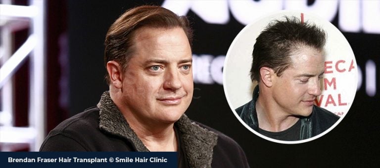 Brendan Fraser Saç Ekimi