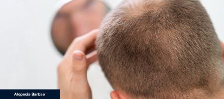 Causes-of-Alopecia-Barbae