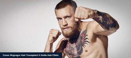 Conor-Mcgregor-Hair-Transplant-01