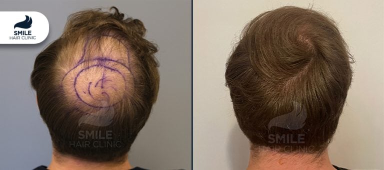 Crown Hair Transplant